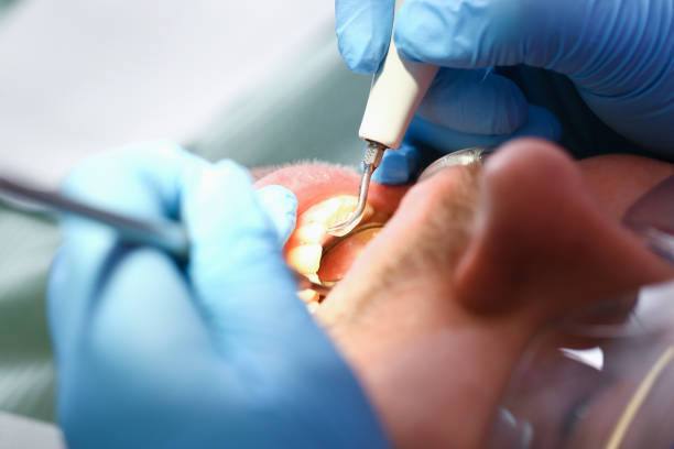 Best Emergency Treatment for Dental Infections or Abscesses in West Brattleboro, VT